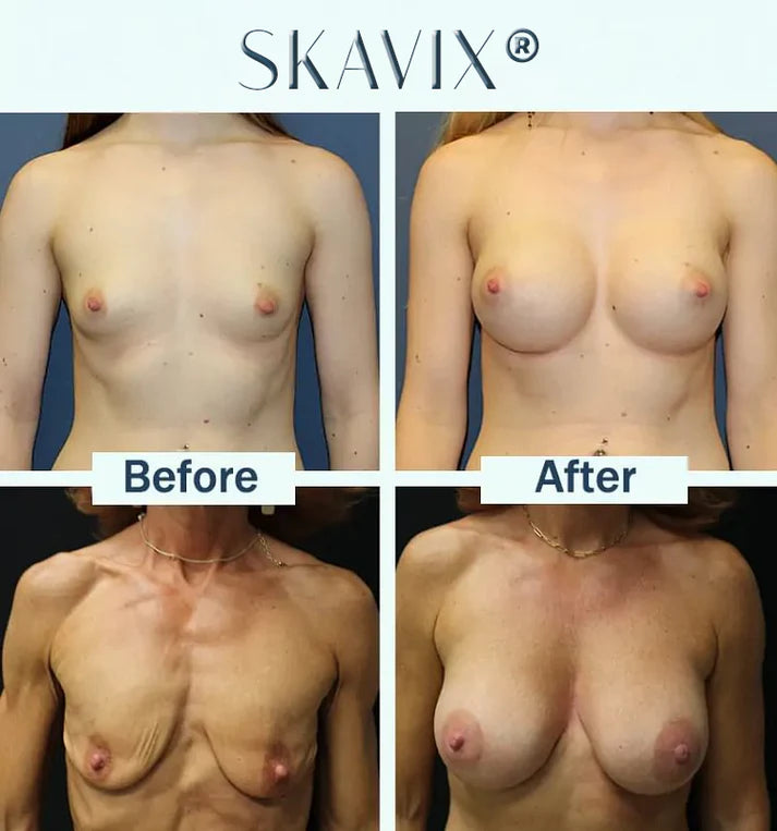 🔥Limited-time d sale-- Skavix Targeted Breast Enhancement Advanced Nano- Microneedle Patches